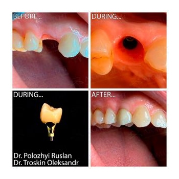 Restoration of tooth with a Neodent implant