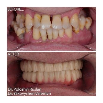 All-on-4 implantation