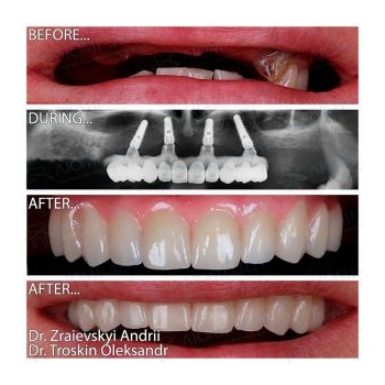dental implants photo Lumident