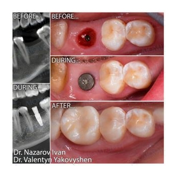 Dental implants photos — Lumident