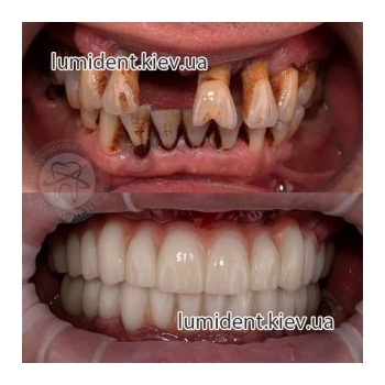 імплантація протезування зубів до та після фото Люмідент