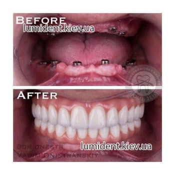 Протезирование зубов до после фото Люми-Дент