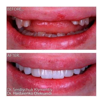 total rehabilitation according to the All-on-4 protocol on Neodent implants