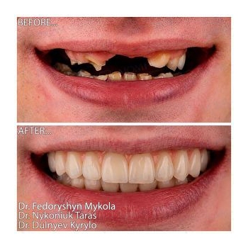 Dental implants before and after photos Kyiv Lumi-Dent 