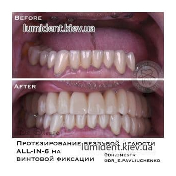 Імплантація зубів фото до та після Київ Люмидент 