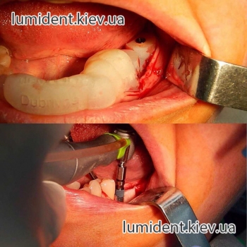 Имплантация зубов с помощью хирургического шаблона