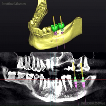 teeth implantation