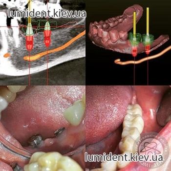 Установка зубных имплантов Киев цена фото Люми-Дент 