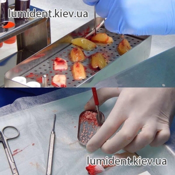 Остеопластика кости перед имплантацией