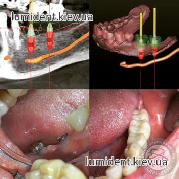 Teeth implantation implants Kiev Ukraine foto Lumi-Dent 