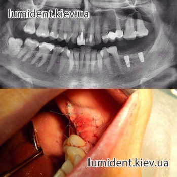 Teeth implantation