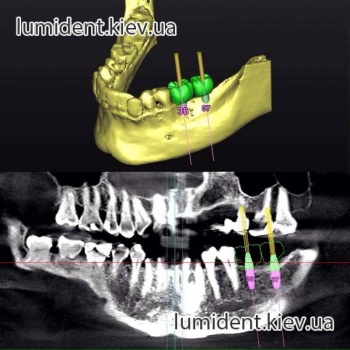 teeth implantation