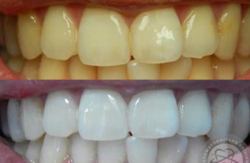 Teeth Whitening Kiev pics photo dentistry LumiDent