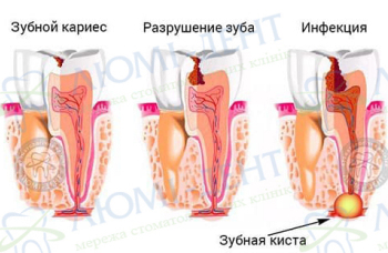 Киста зуба удаление лечение Киев фото ЛюмиДент