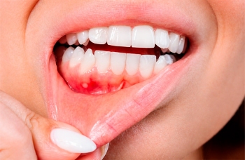 Кіста зуба видалення лікування Київ фото ЛюміДент