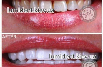 Керамічні вініри на зуби фото до та після Київ фото Люмі-Дент 