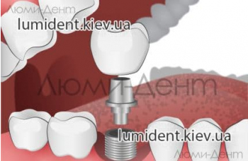 Имплантация зубов Киев цена фото Люми-Дент 