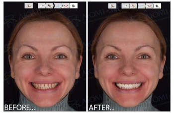 Digital smile design фото ЛюмиДент