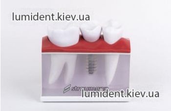 Съемные и несъемные зубные протезы на имплантах Киев фото ЛюмиДент