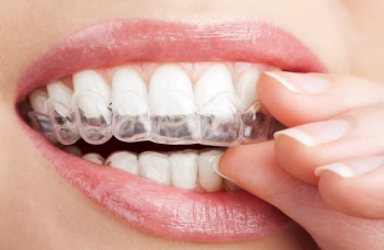Ортодонтичні Ретейнери для зубів фото ЛюміДент
