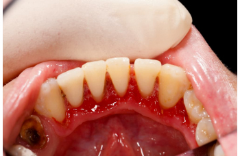 Inflammation of the gums Periodontist Kiev treatment photo Lumi-Dent
