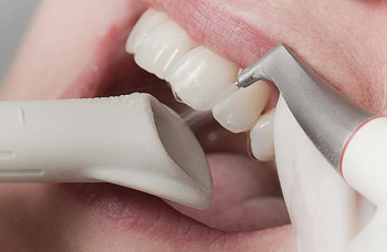 Ultrasonic teeth cleaning