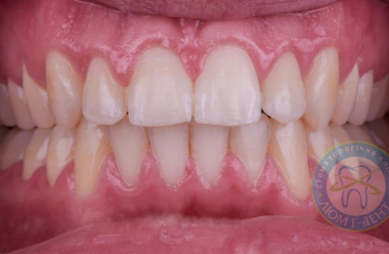 Види правильного і неправильного прикусу зубів