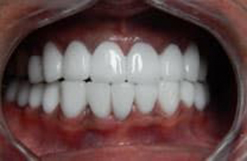 Протезування зубів Київ види зубних протезів фото Люмі-Дент