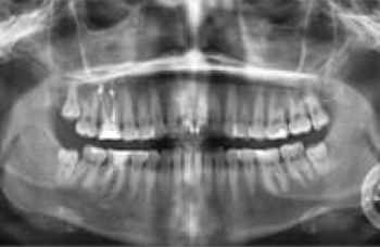 Панорамный снимок ОПТГ зубов Киев ортопантомограмма фото ЛюмДент