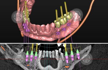 Імплантація протезування зубів Киів фото Люмі-Дент