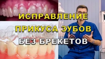 Ортодонтія без брекетів. Вирівнювання прикусу капами