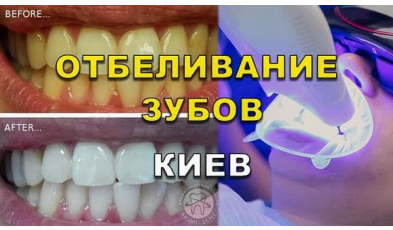 Отбеливание зубов - видео