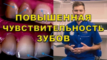 Повышенная чувствительность зубов